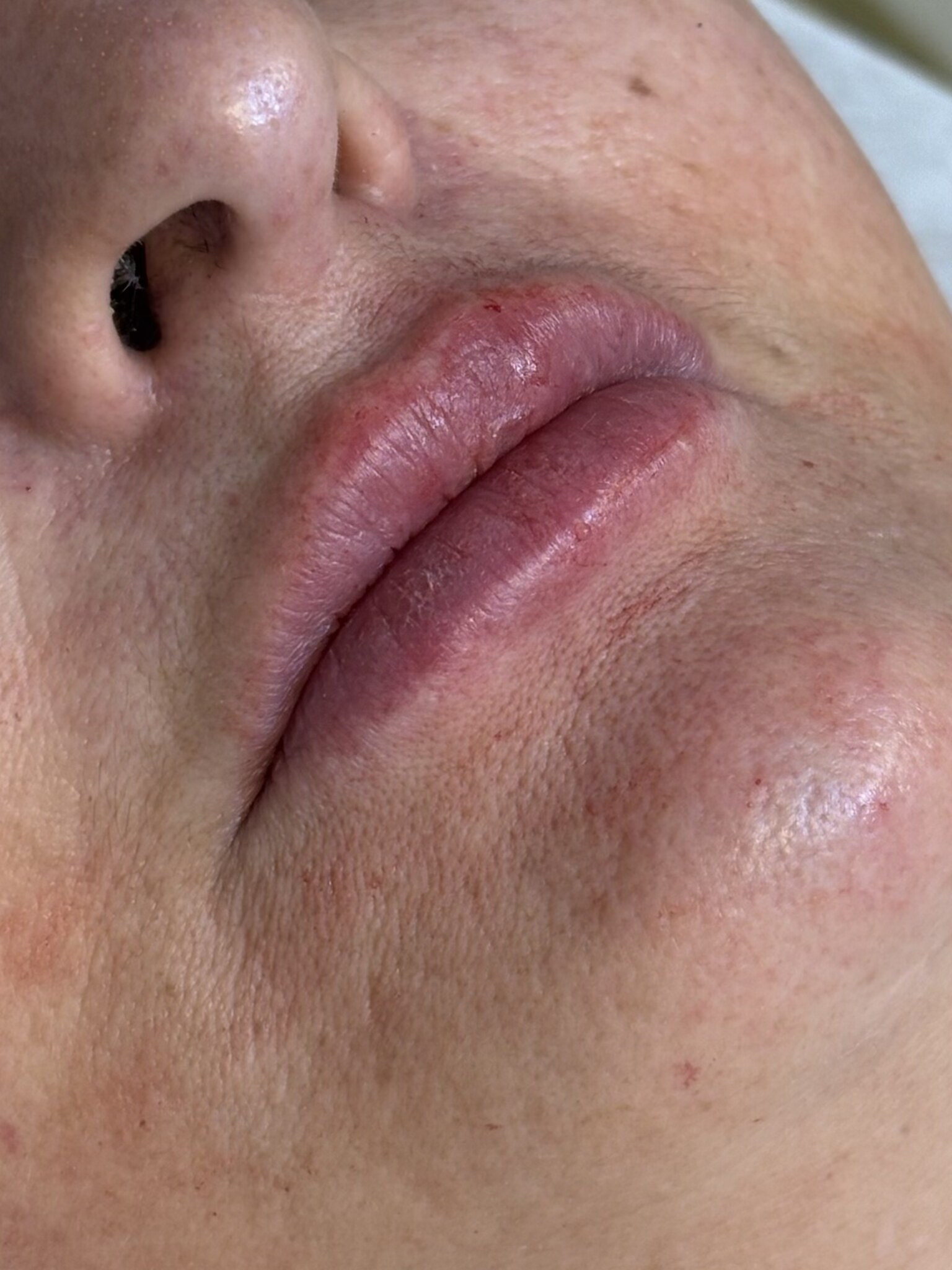 Preenchimento labial — Depois 4