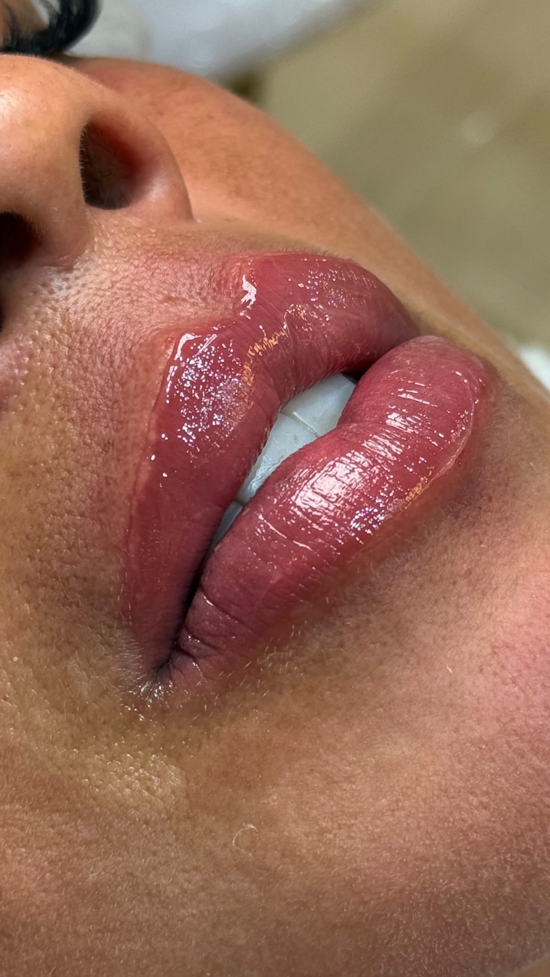 Preenchimento labial — Depois 2