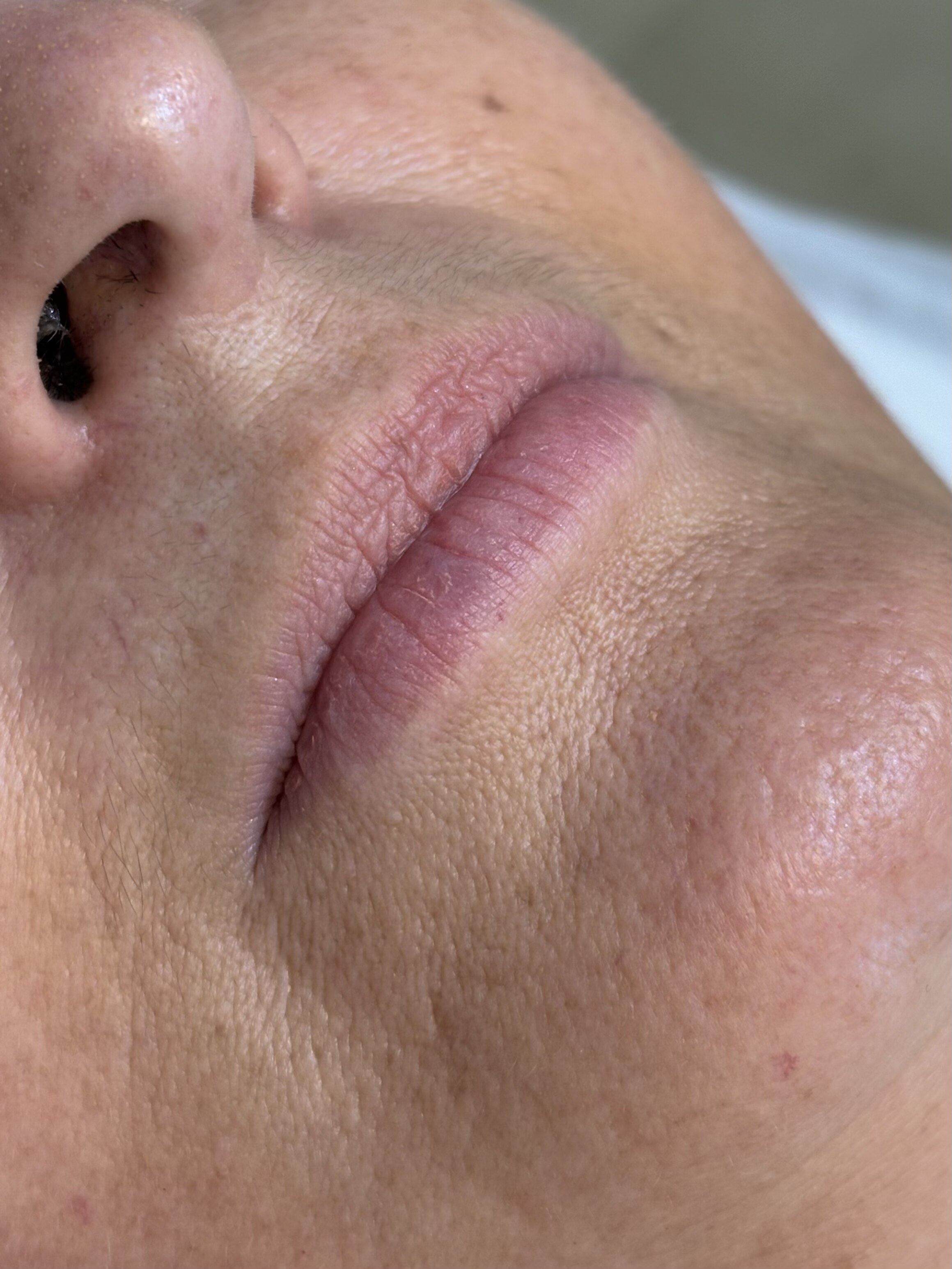 Preenchimento labial — Antes 3